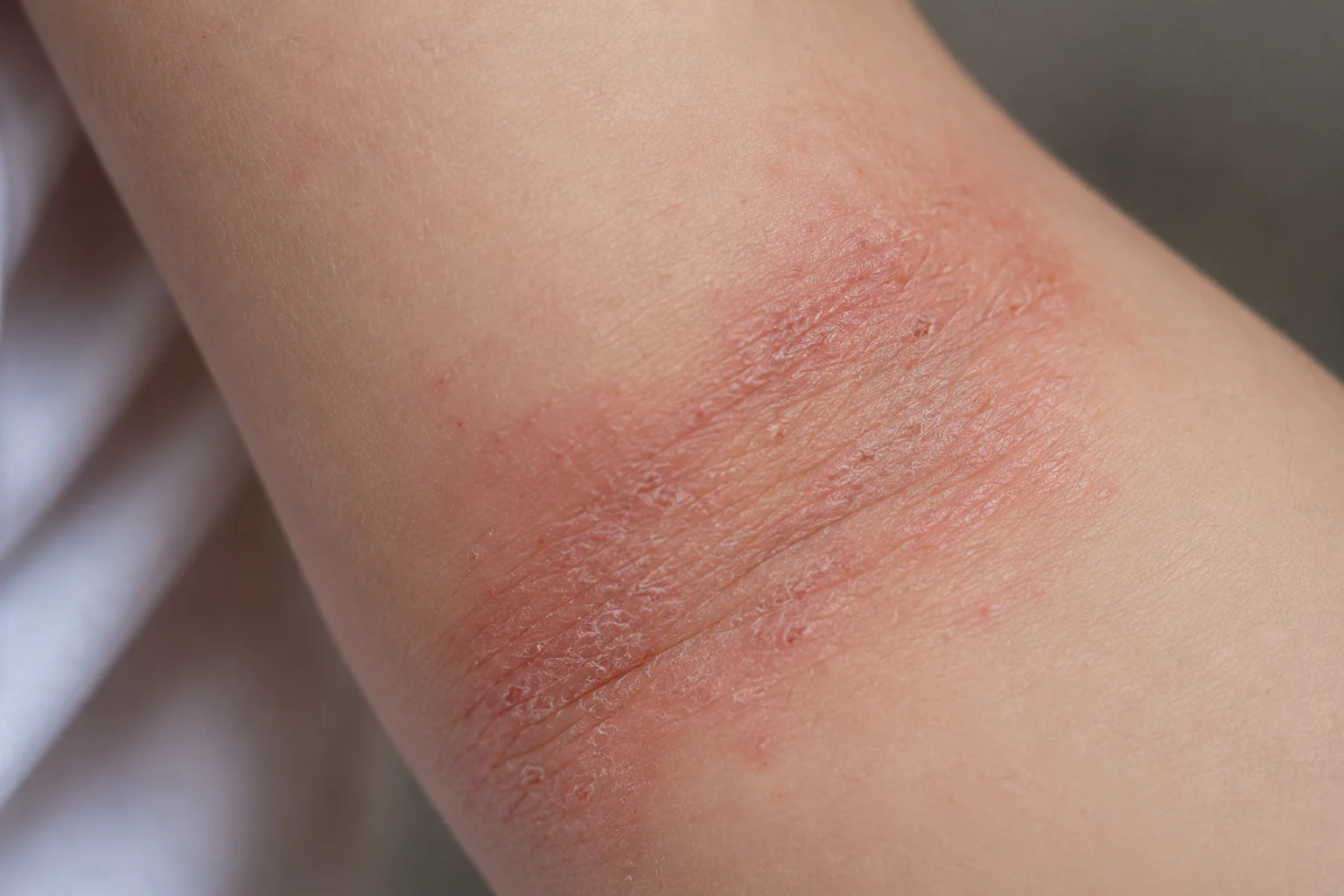 Eczema in Children: Causes, Symptoms, and How to Manage Flare-Ups