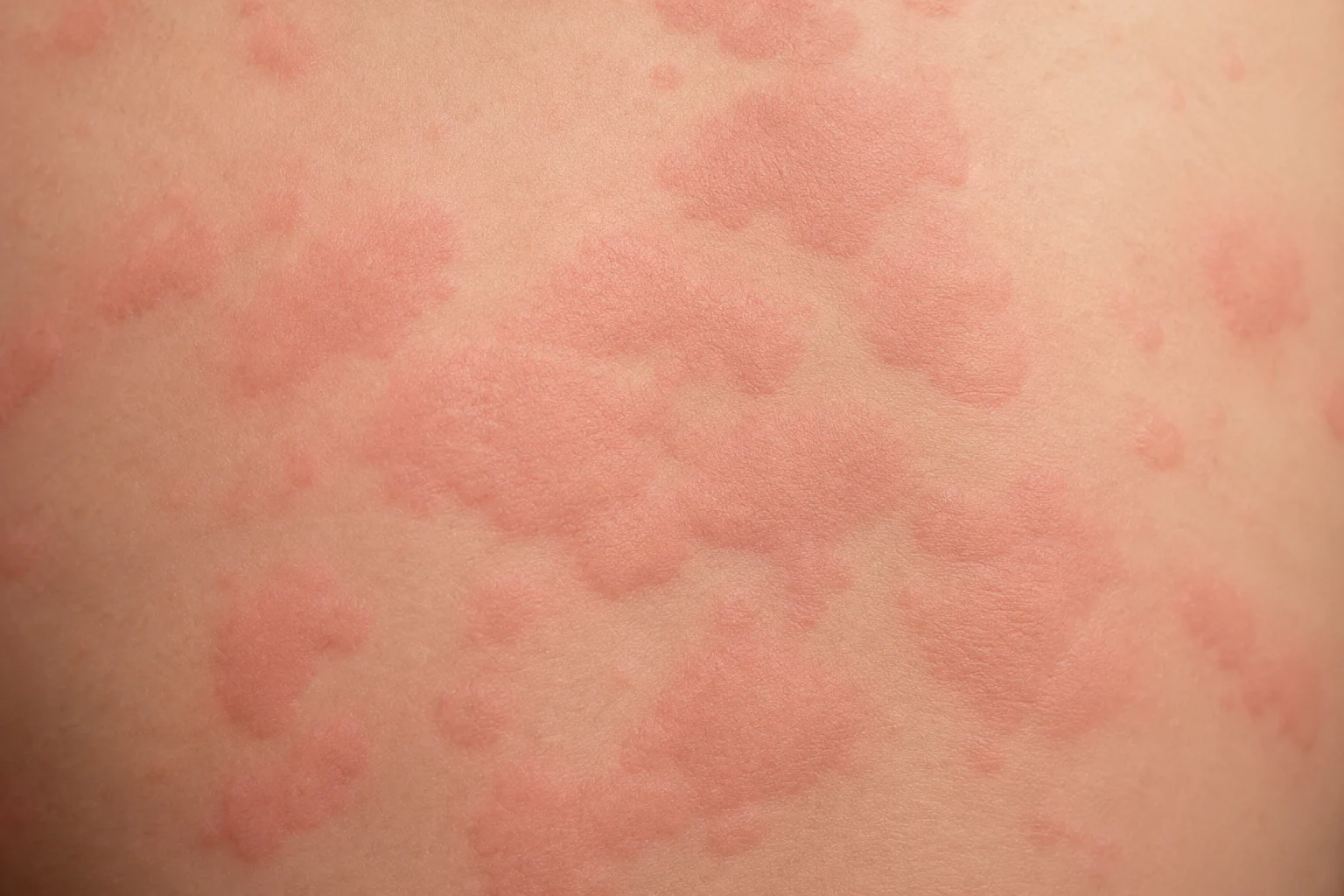 Hives in Children: Common Causes, Types, and When to Worry