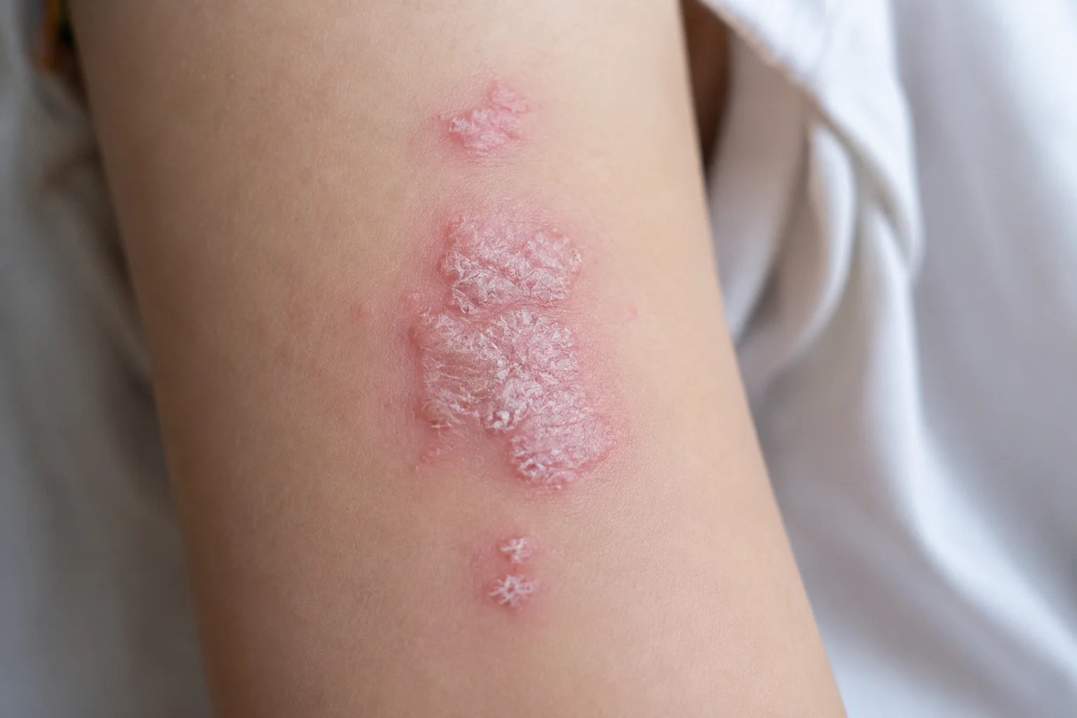 Psoriasis in Children: What Parents Should Know About Symptoms and Treatment